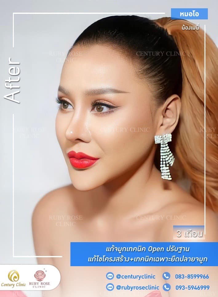Century รีวิว แก้จมูก #249