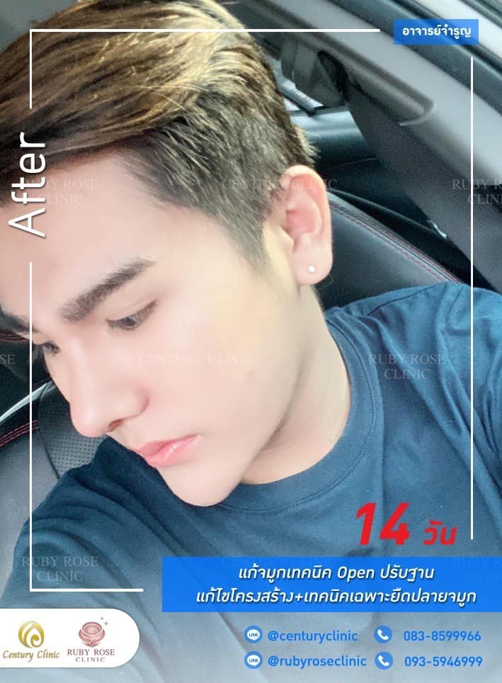 Century รีวิว แก้จมูก #251