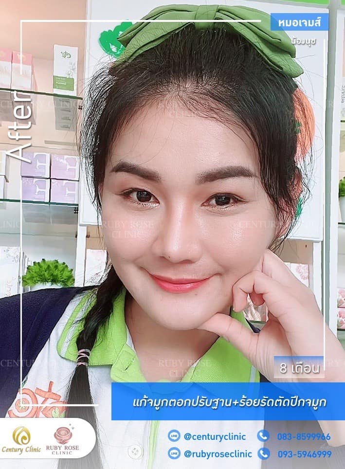 Century รีวิว แก้จมูก #259