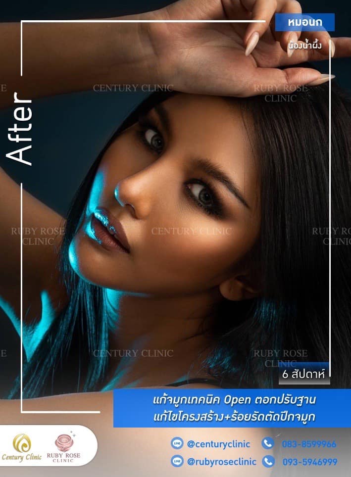 Century รีวิว แก้จมูก #260