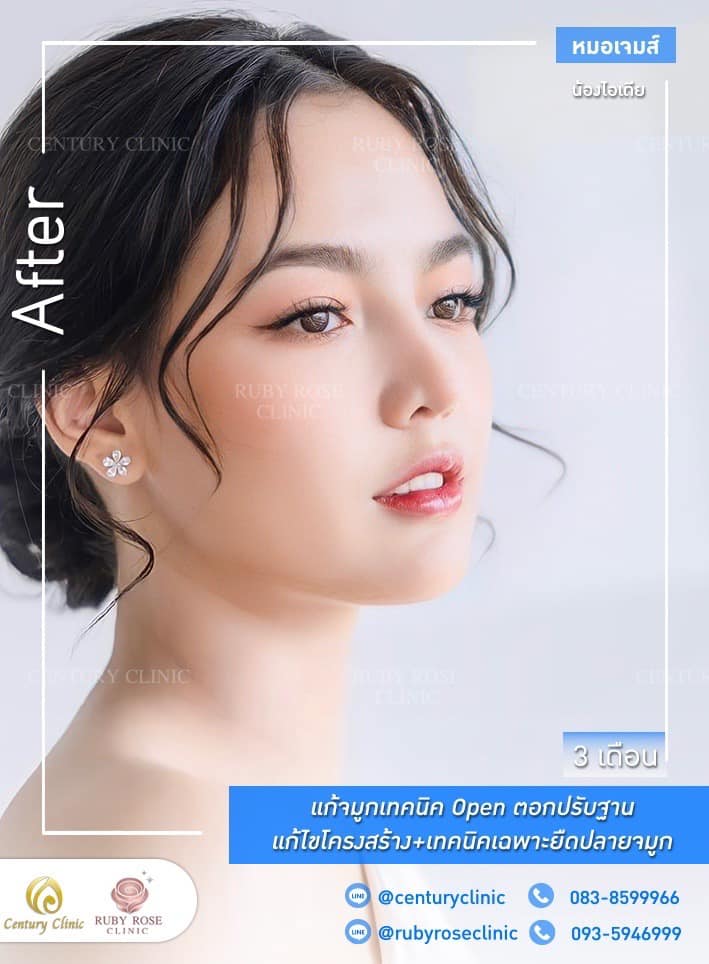 Century รีวิว แก้จมูก #262