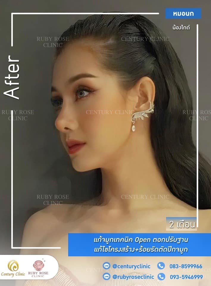 Century รีวิว แก้จมูก #264