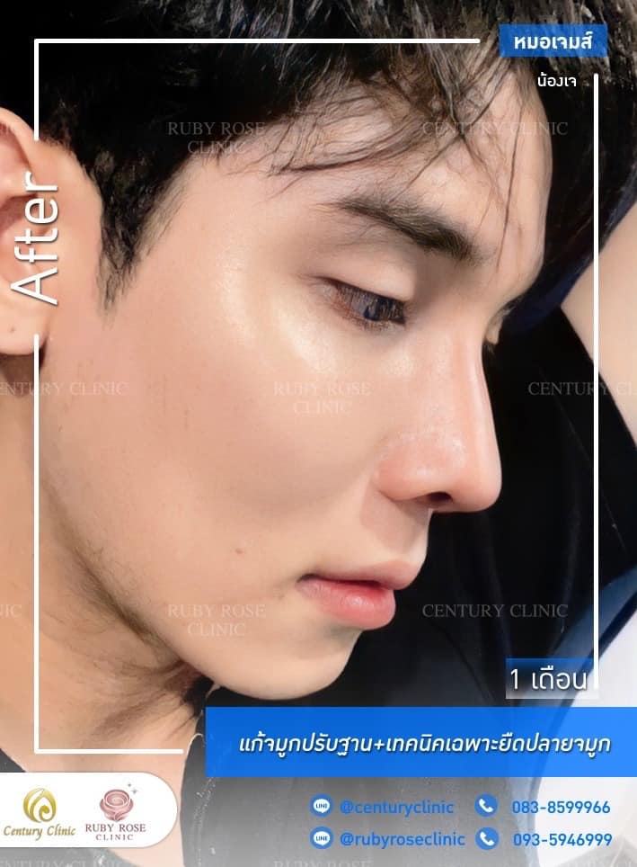 Century รีวิว แก้จมูก #265
