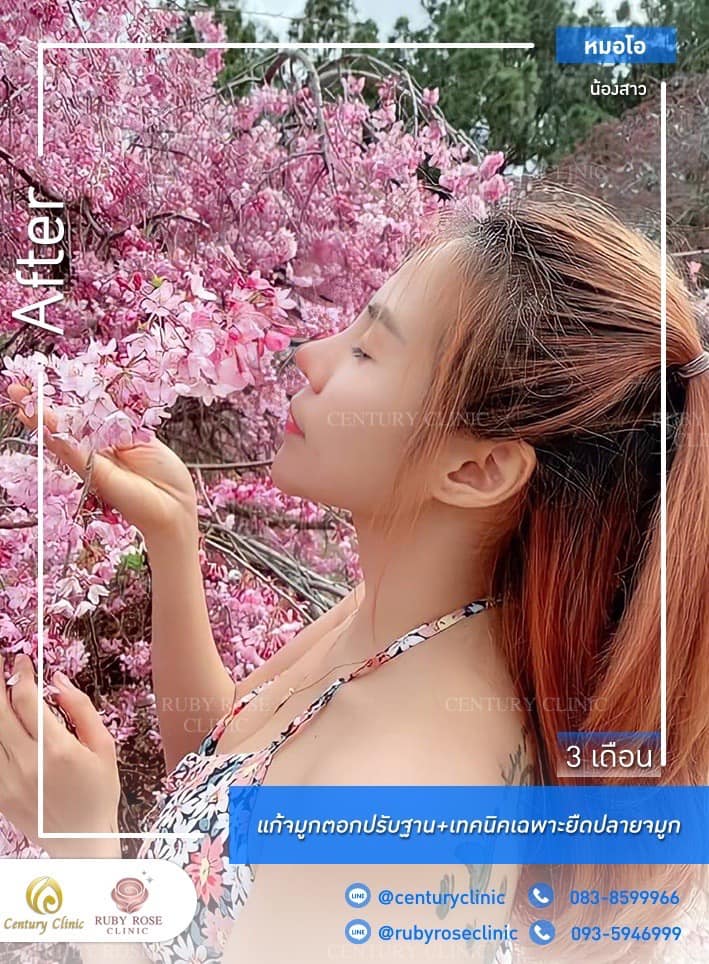Century รีวิว แก้จมูก #268