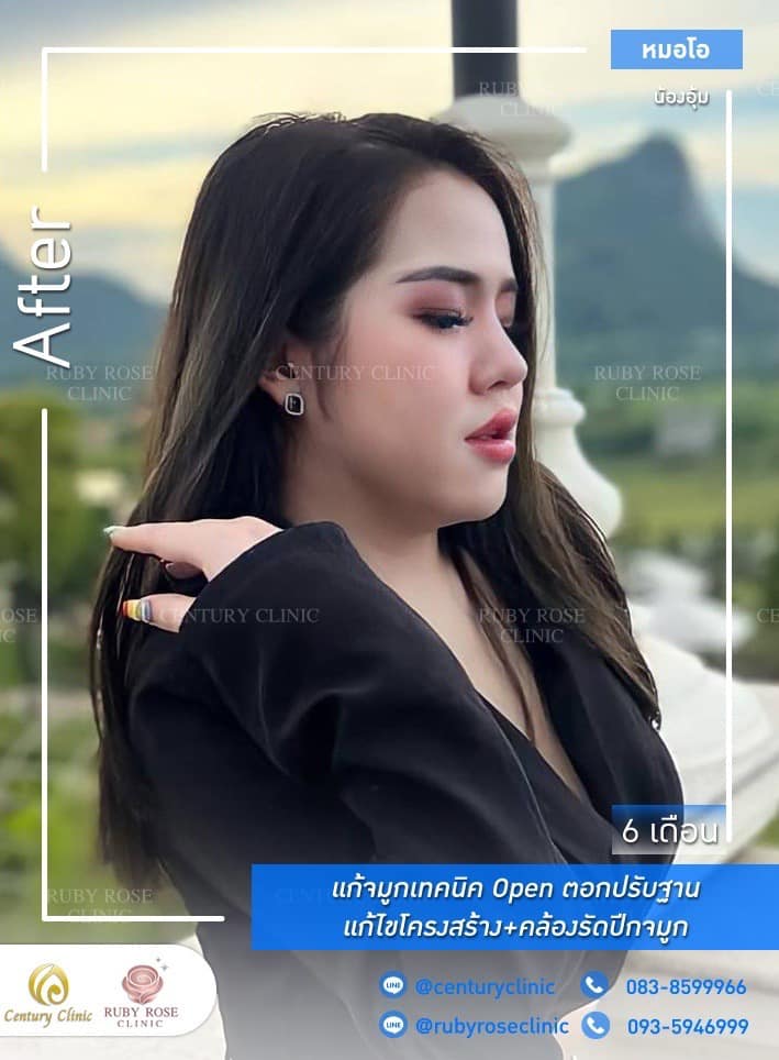 Century รีวิว แก้จมูก #271