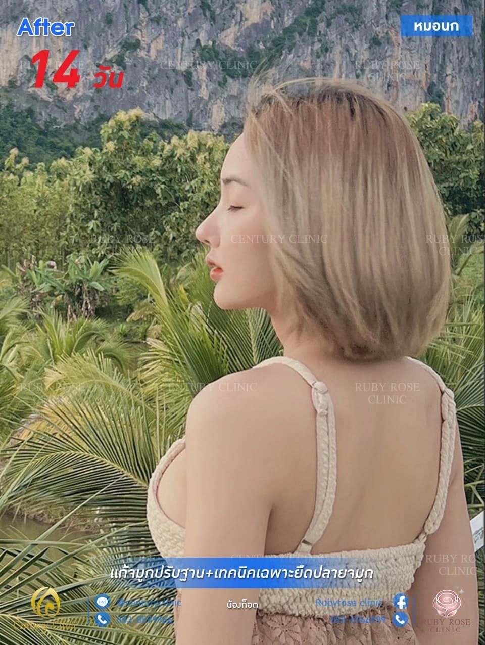 Century รีวิว แก้จมูก #272