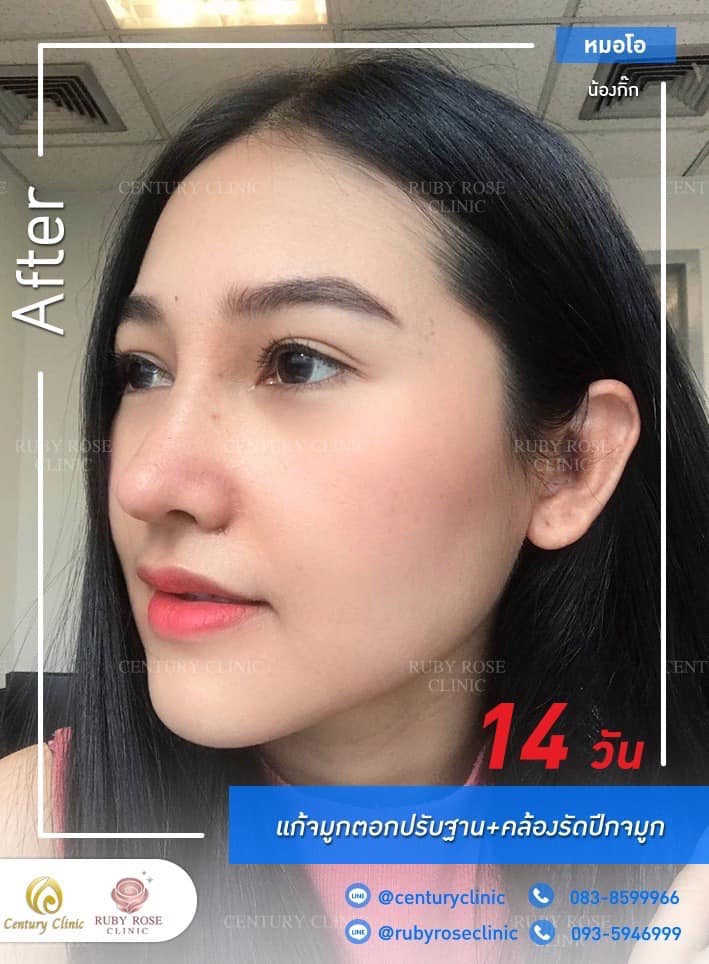 Century รีวิว แก้จมูก #275
