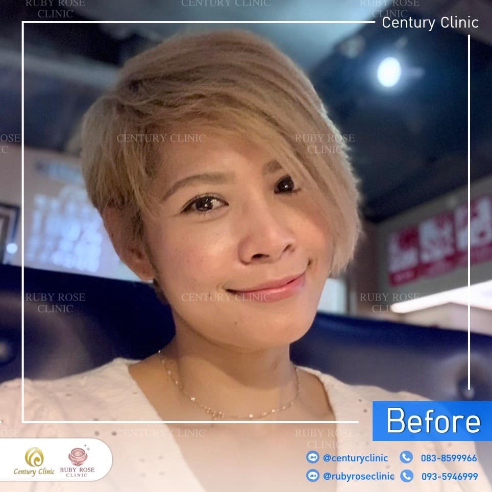 รีวิว แก้จมูก #216 , Century Clinic Thailand Century รีวิว แก้จมูก 3#216