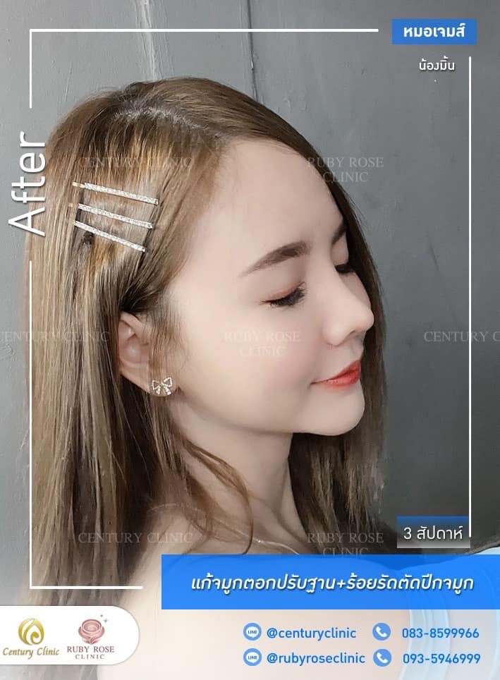 Century รีวิว แก้จมูก1 #221