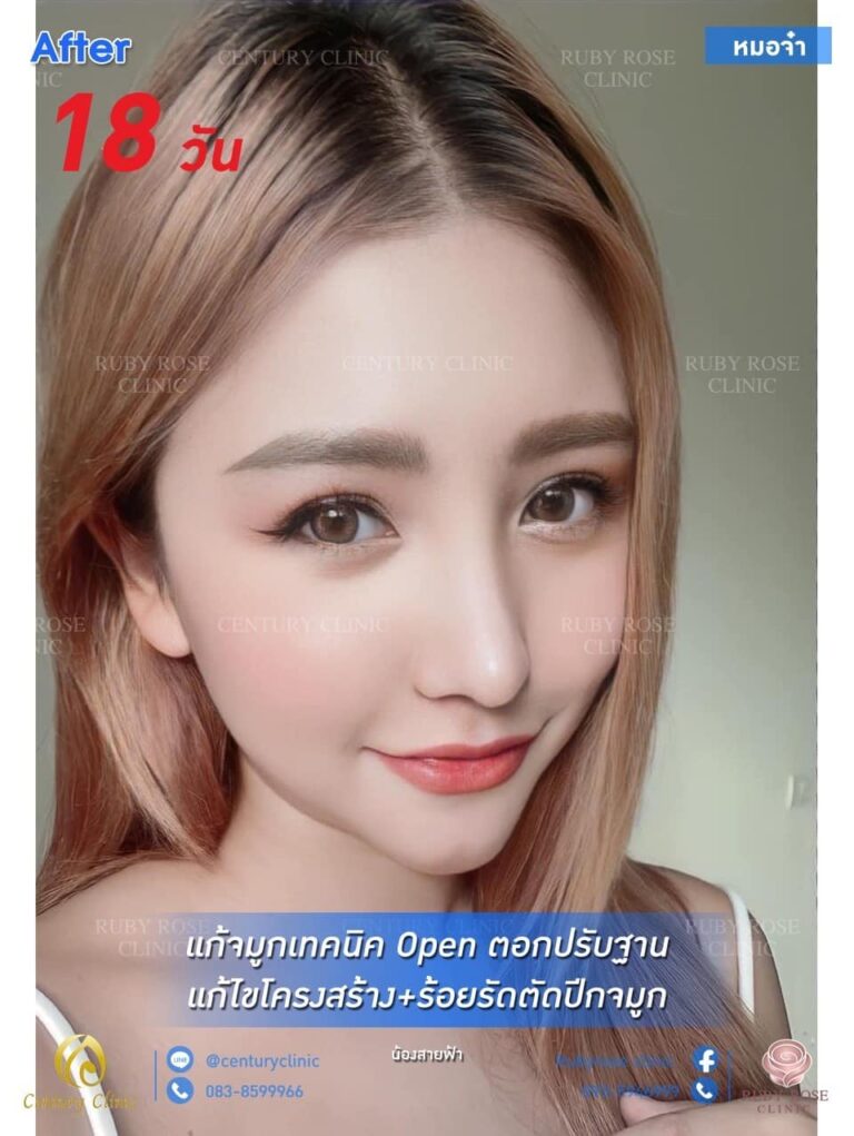 Century รีวิว แก้จมูก#155