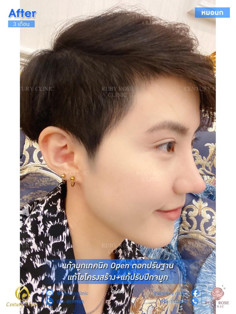 Century รีวิว แก้จมูก2 #158