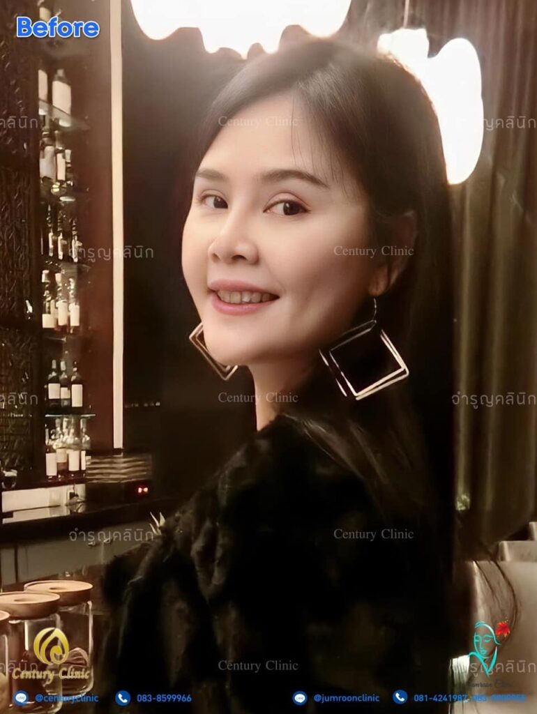 รีวิว แก้จมูก #159 , Century Clinic Thailand Century รีวิว แก้จมูก2 #159