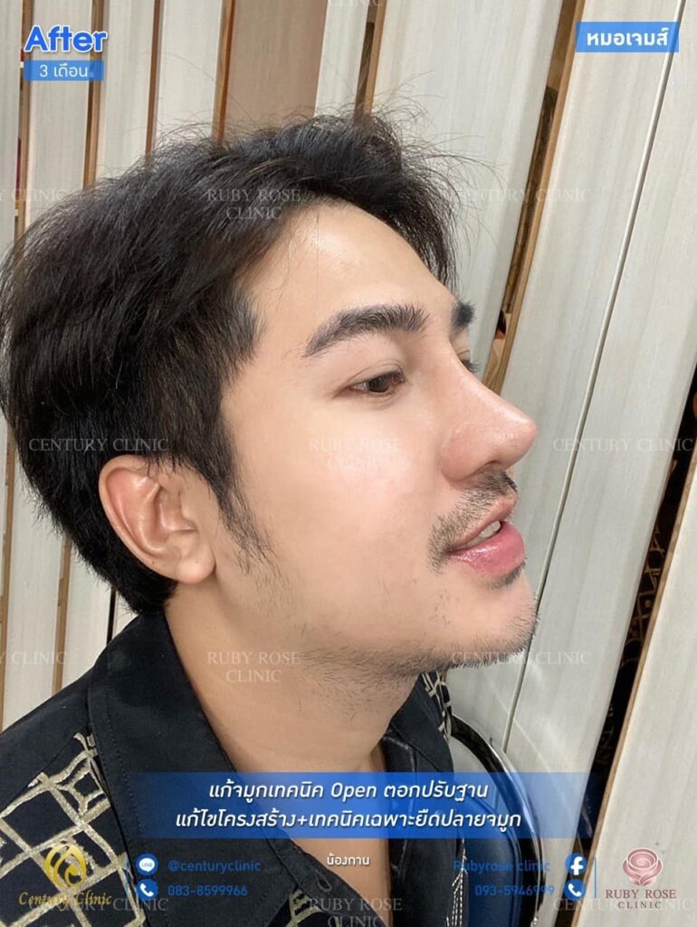 Century รีวิว แก้จมูก2#156