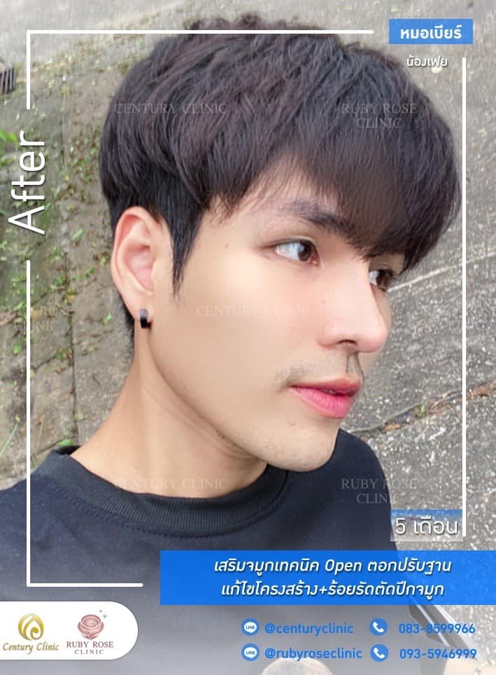 Century รีวิว เสริมจมูก 1#280