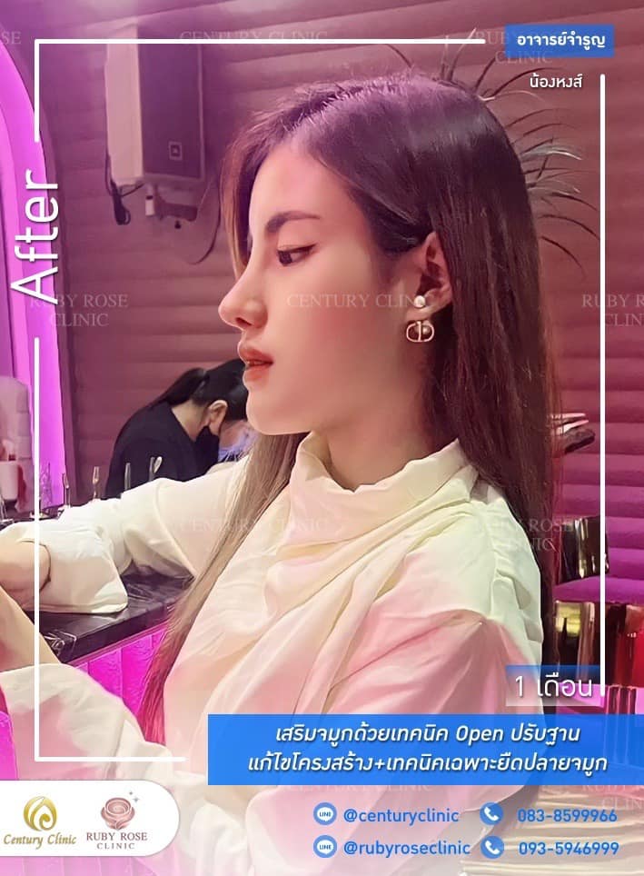 รีวิว เสริมจมูก #281 , Century Clinic Thailand Century รีวิว เสริมจมูก 1#281