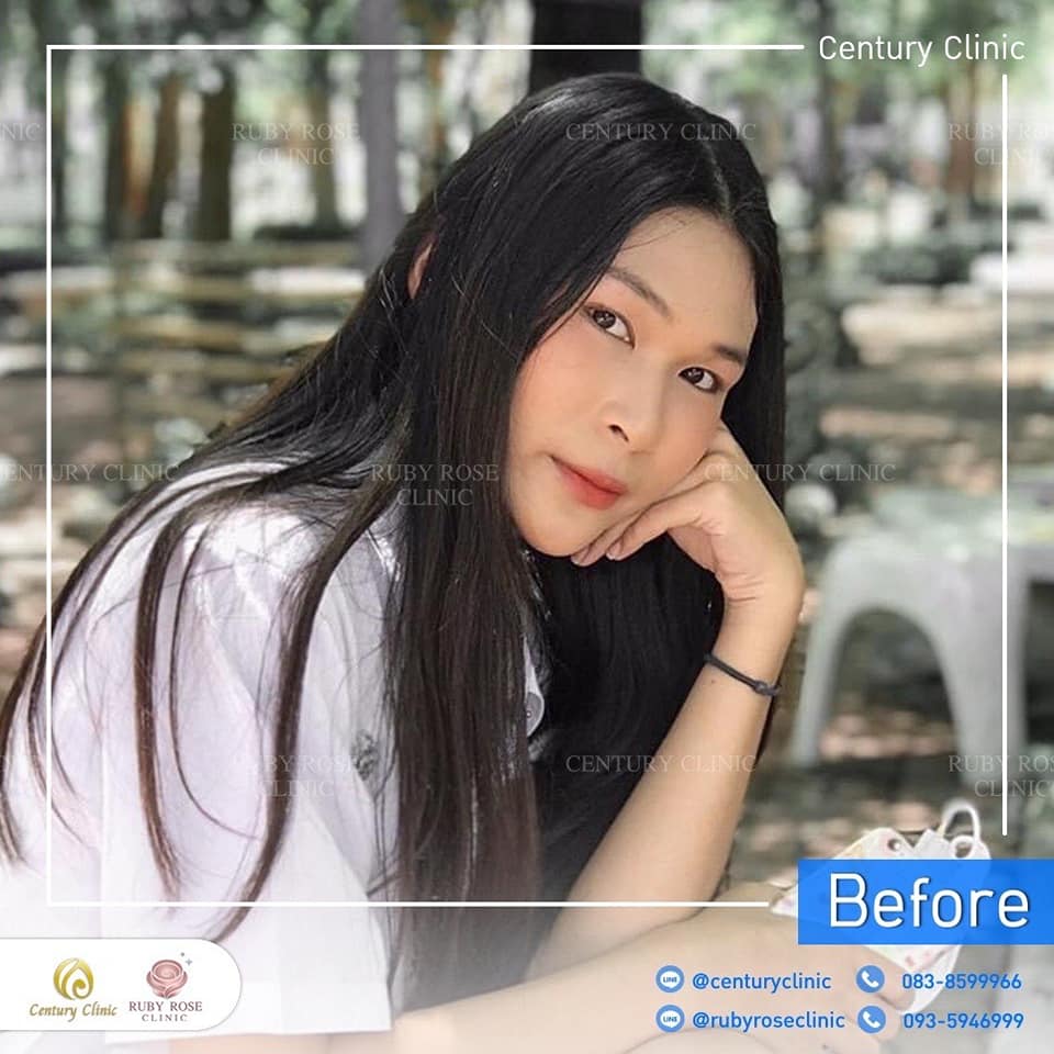 รีวิว เสริมจมูก #300 , Century Clinic Thailand Century-รีวิว-เสริมจมูก 1#300