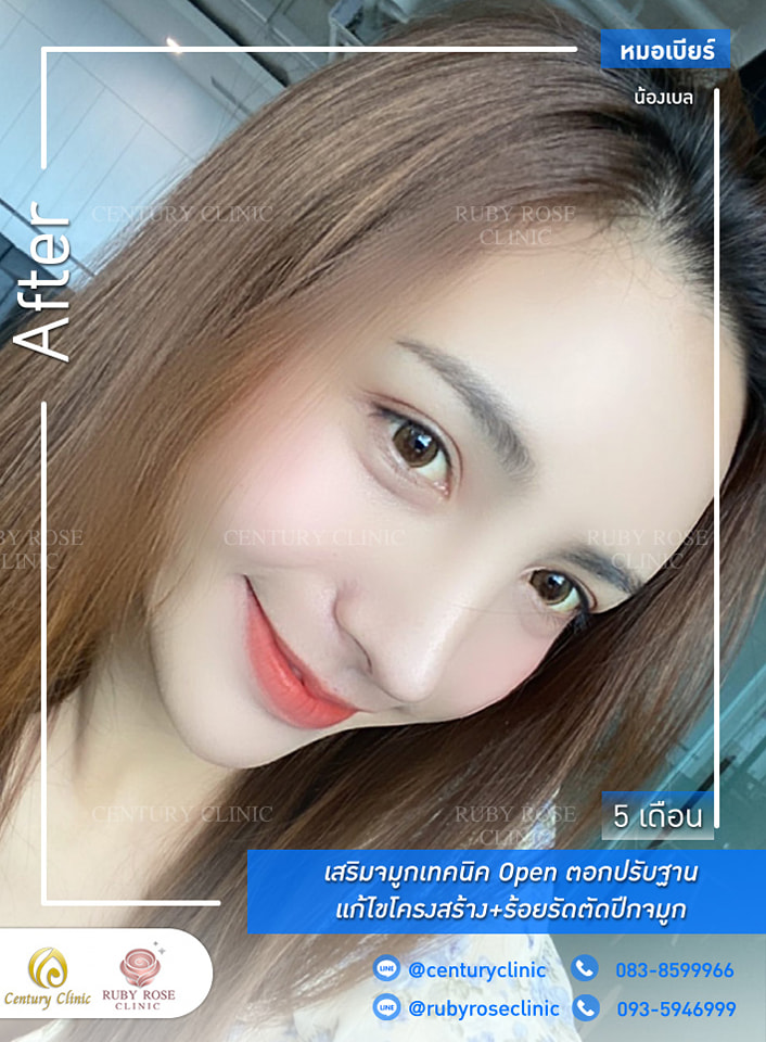รีวิว เสริมจมูก #306 , Century Clinic Thailand Century-รีวิว-เสริมจมูก 1#306