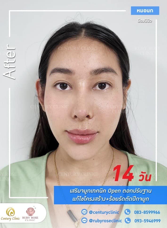 Century-รีวิว-เสริมจมูก 1#310