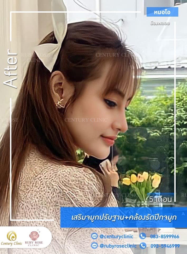 Century-รีวิว-เสริมจมูก 1#315