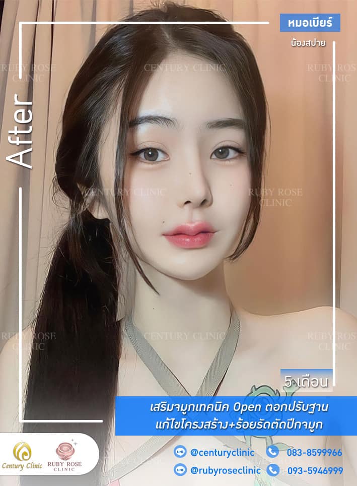 Century-รีวิว-เสริมจมูก 1#326