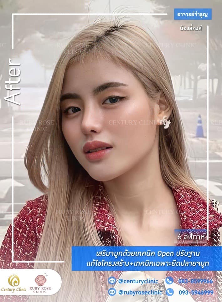 Century-รีวิว-เสริมจมูก 1#331