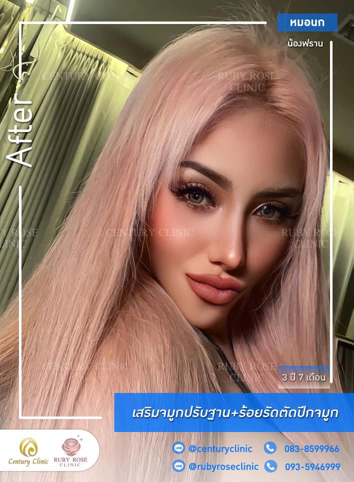 รีวิว เสริมจมูก #347 , Century Clinic Thailand Century-รีวิว-เสริมจมูก 1#347