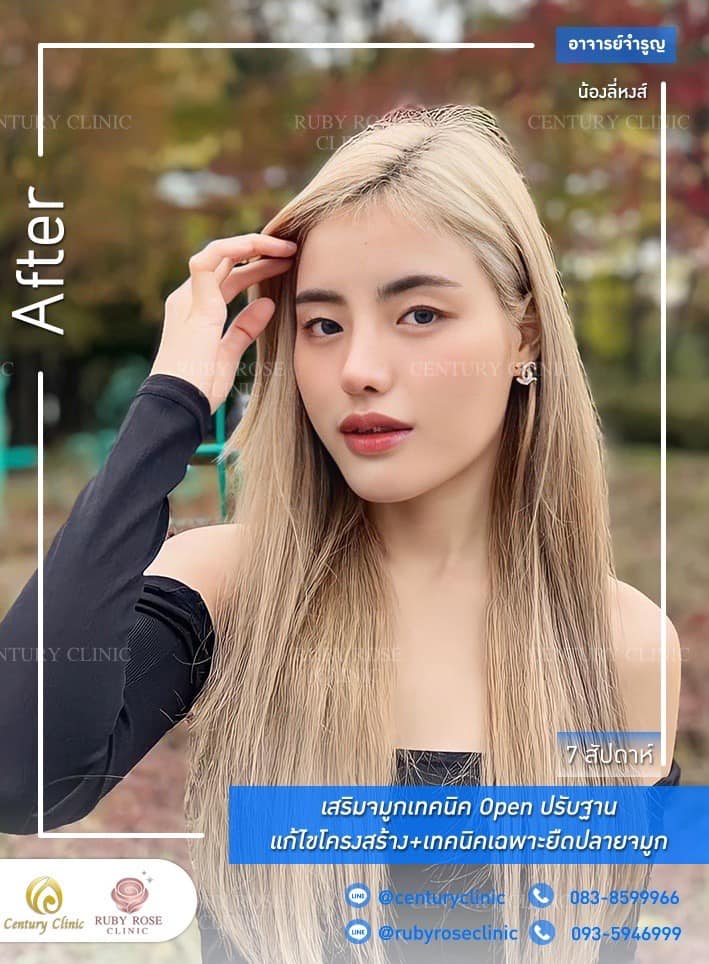 Century-รีวิว-เสริมจมูก 1#350