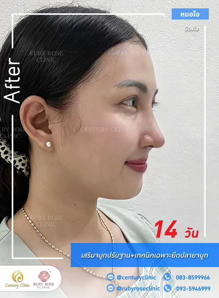 รีวิว เสริมจมูก #356 , Century Clinic Thailand Century-รีวิว-เสริมจมูก 1#356