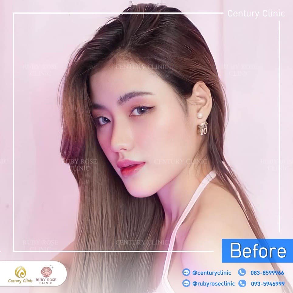 รีวิว เสริมจมูก #281 , Century Clinic Thailand Century รีวิว เสริมจมูก 2#281