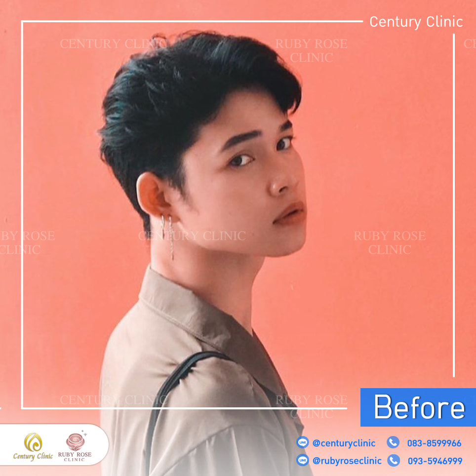 รีวิว เสริมจมูก #301 , Century Clinic Thailand Century-รีวิว-เสริมจมูก 2#301
