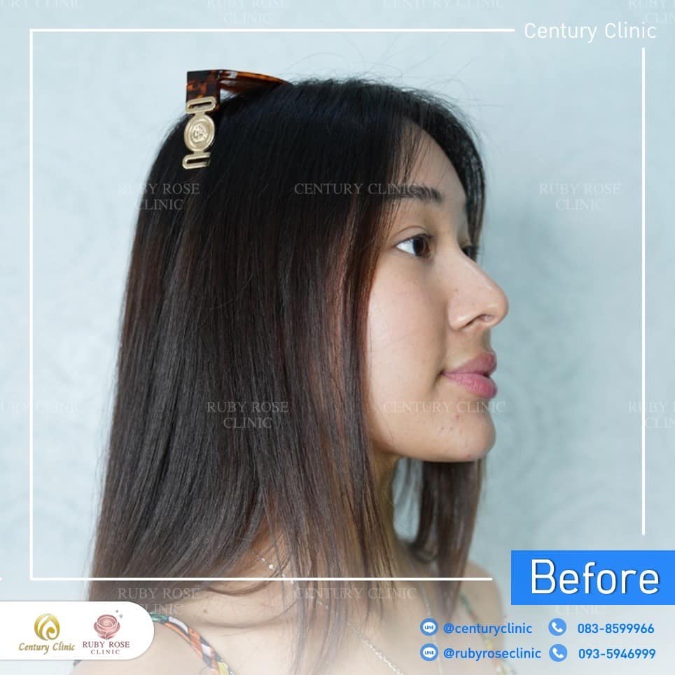 Century-รีวิว-เสริมจมูก 2#310