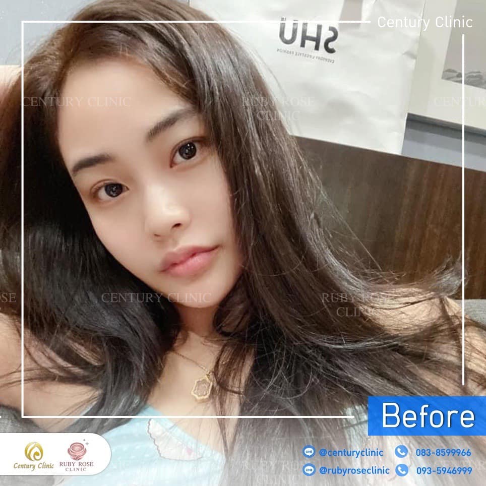Century-รีวิว-เสริมจมูก 2#315