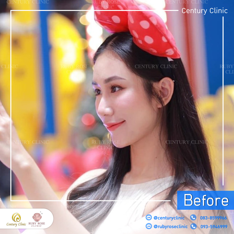 รีวิว เสริมจมูก #320 , Century Clinic Thailand Century-รีวิว-เสริมจมูก 2#320