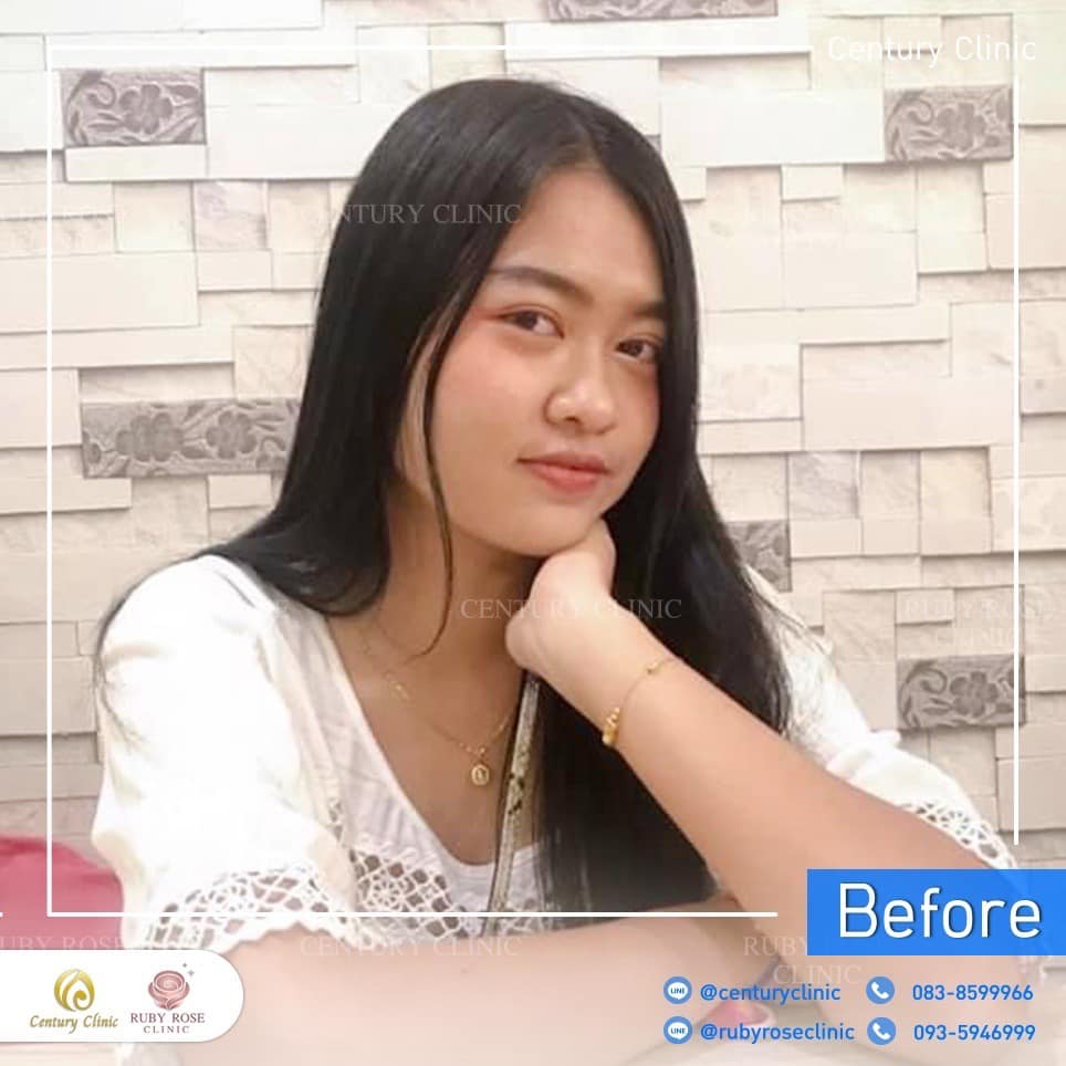 Century-รีวิว-เสริมจมูก 2#355