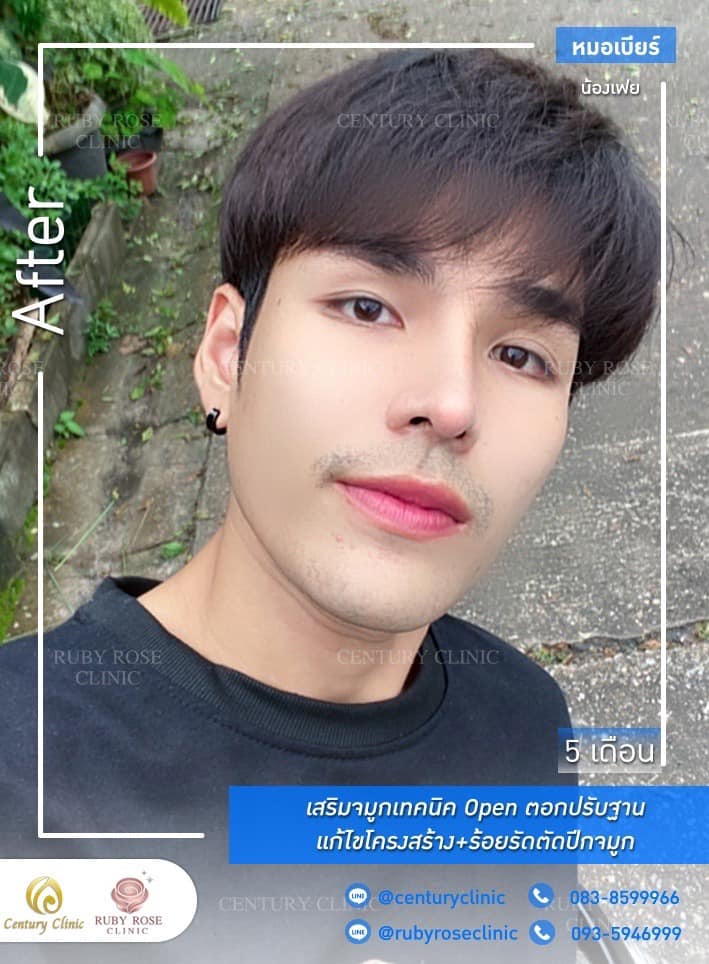 Century รีวิว เสริมจมูก #280