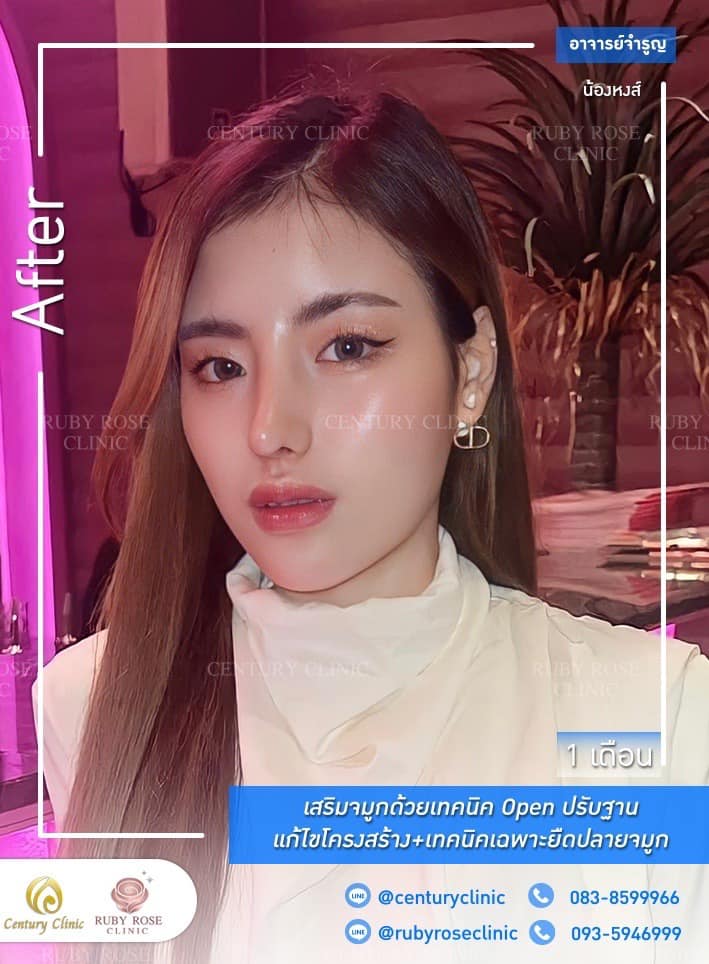 Century รีวิว เสริมจมูก #281