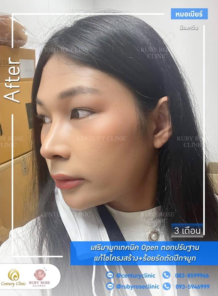 Century-รีวิว-เสริมจมูก #300