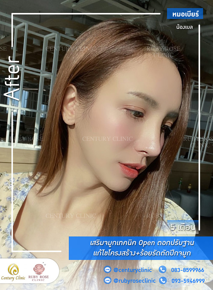Century-รีวิว-เสริมจมูก #306