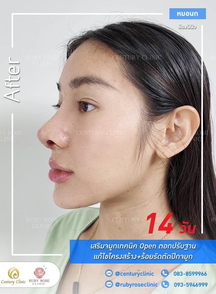 Century-รีวิว-เสริมจมูก 1#310