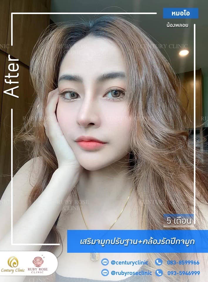 Century-รีวิว-เสริมจมูก #315