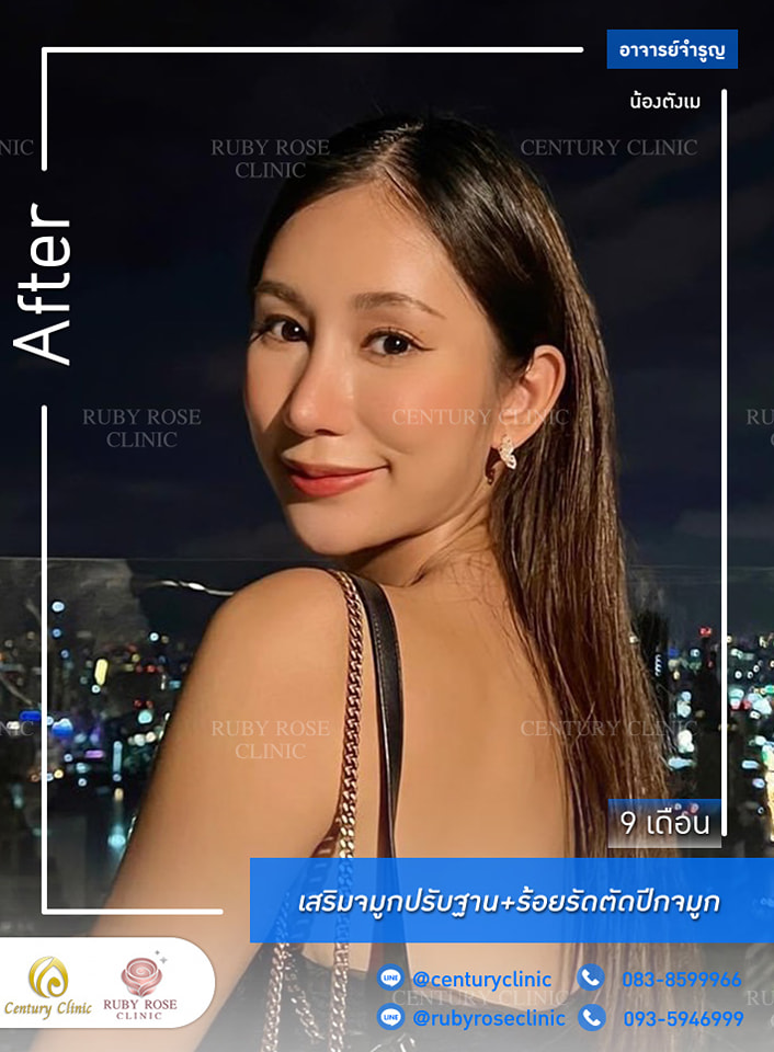 Century-รีวิว-เสริมจมูก #320