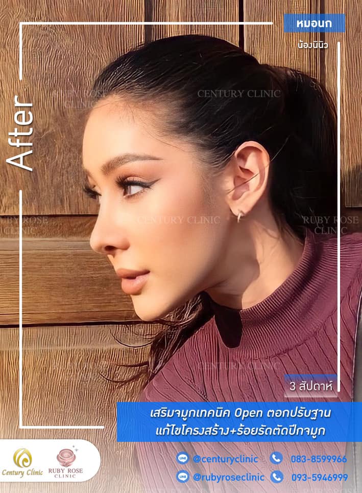 Century-รีวิว-เสริมจมูก #323