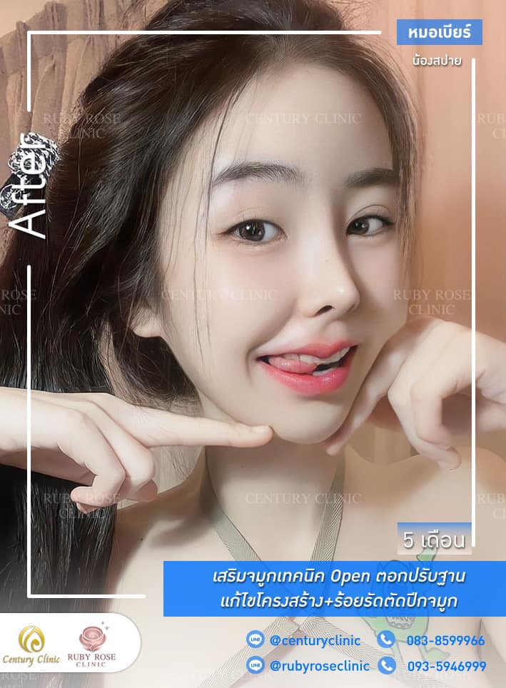 Century-รีวิว-เสริมจมูก #326