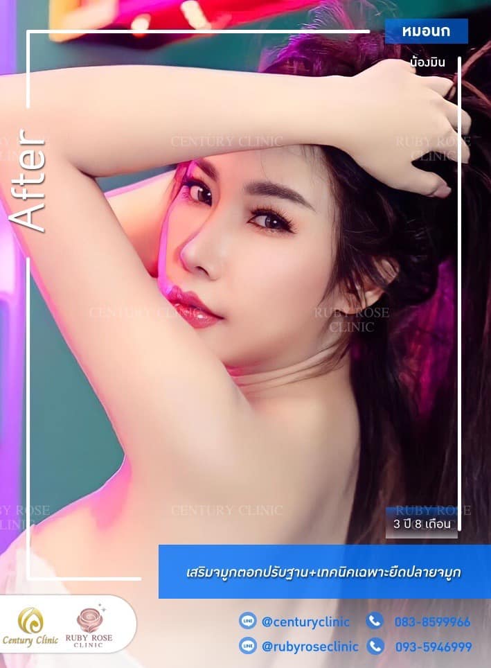 Century-รีวิว-เสริมจมูก 1#327