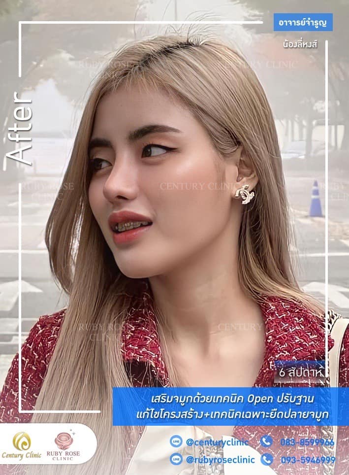 Century-รีวิว-เสริมจมูก 2#331