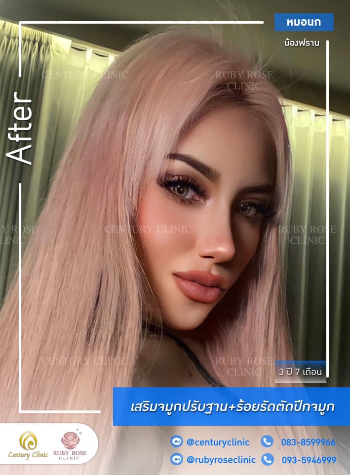 รีวิว เสริมจมูก #347 , Century Clinic Thailand Century-รีวิว-เสริมจมูก #347