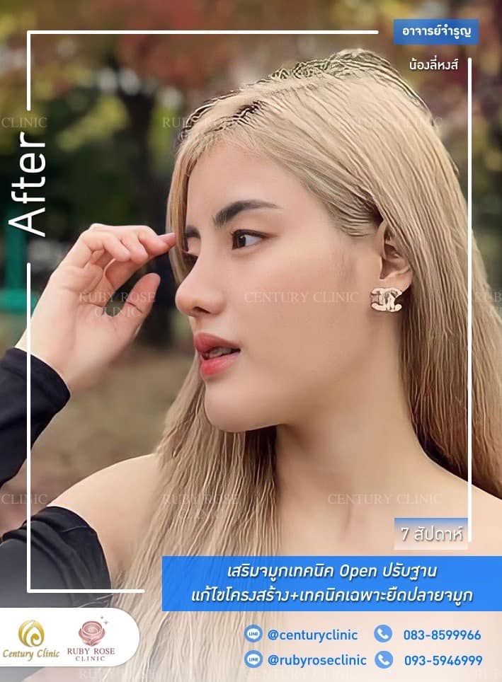 Century-รีวิว-เสริมจมูก #350