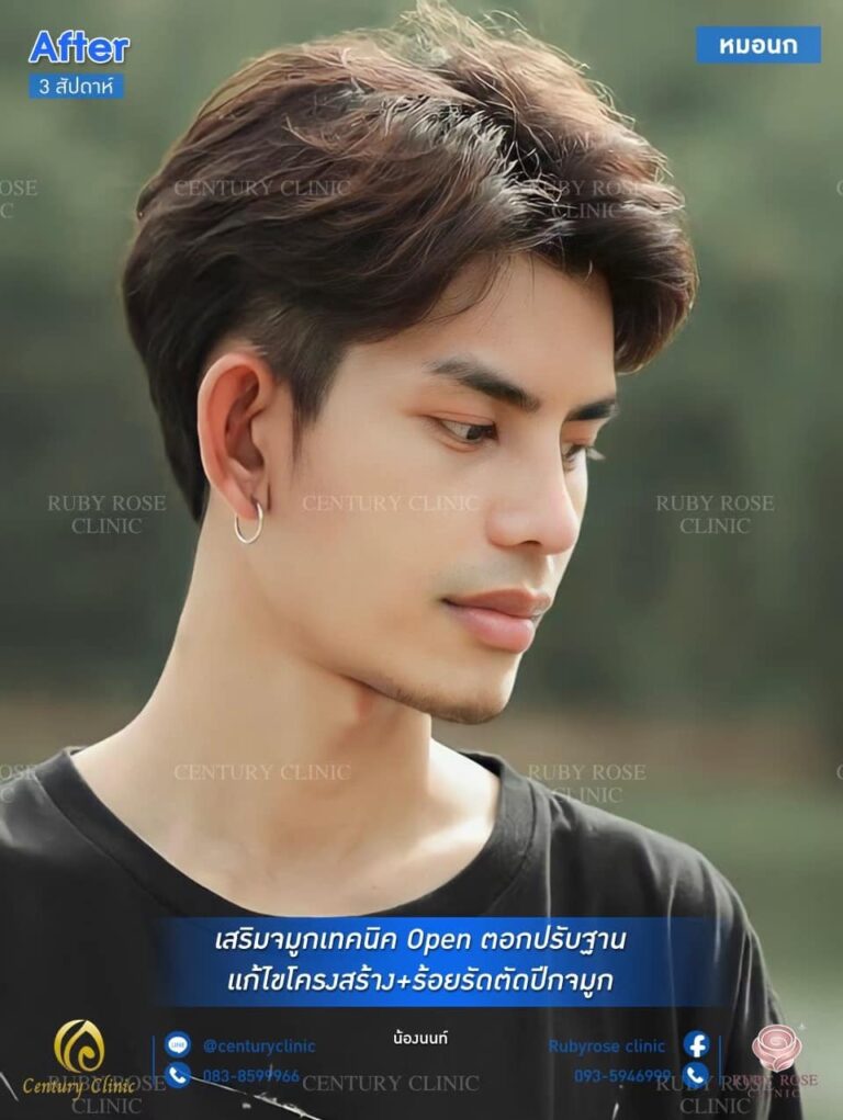 Century-รีวิว-เสริมจมูก #354