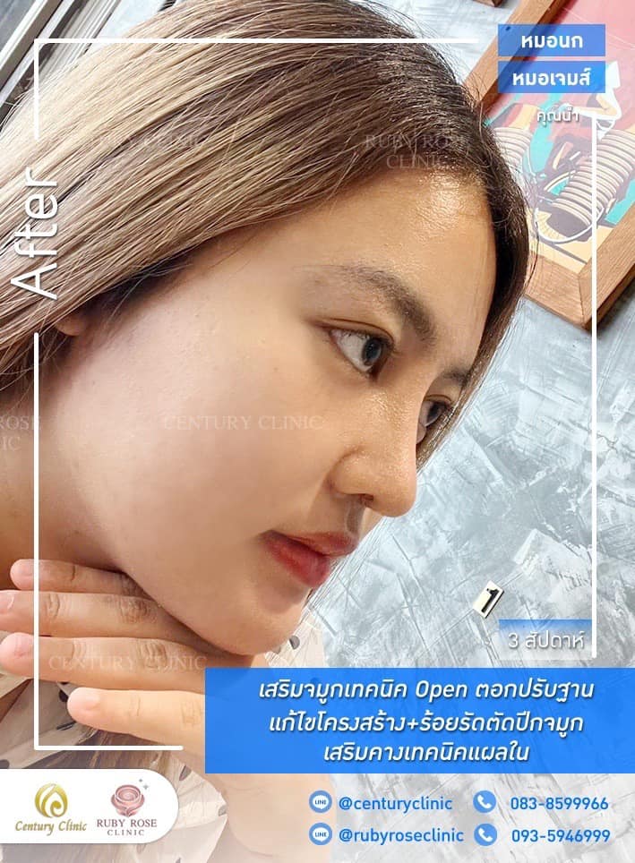 Century-รีวิว-เสริมจมูก #355