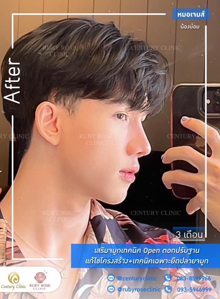 รีวิว เสริมจมูก #357 , Century Clinic Thailand Century-รีวิว-เสริมจมูก #357